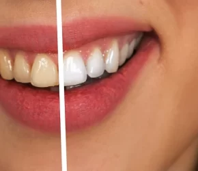 Branqueamento-Dentes-DentalArt